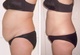 before and after abdomen